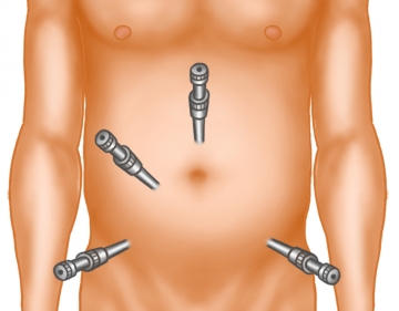 Anlage des Pneumoperitoneums – Trokarpositionierung