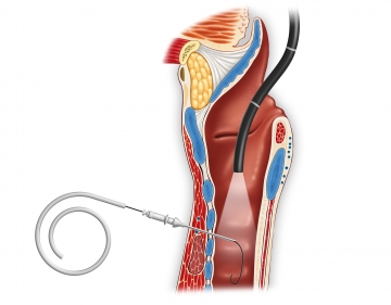 Punktion der Trachea und Einführen des Seldinger-Drahtes