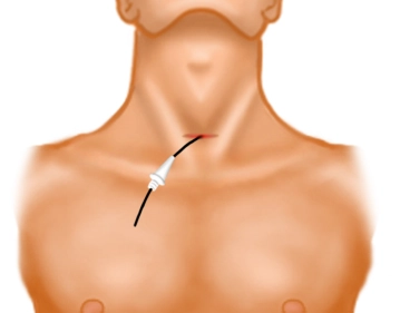 Hautinzision und Einführen des Dilatators