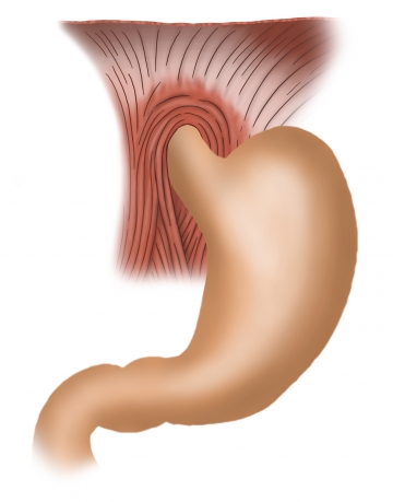 Chirurgische Anatomie des Magens