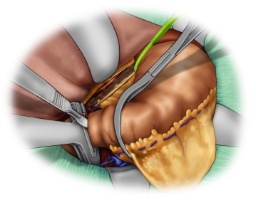 Absetzen des Duodenums