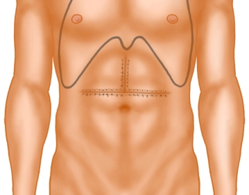 Verschluß des Abdomen