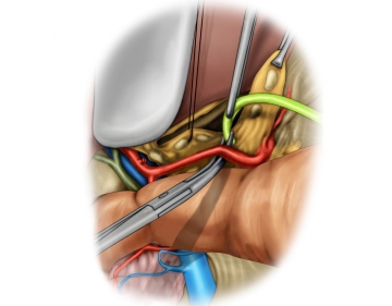 Präparation des Ligamentum hepatoduodenale mit Absetzen der Arteria gastrica dextra