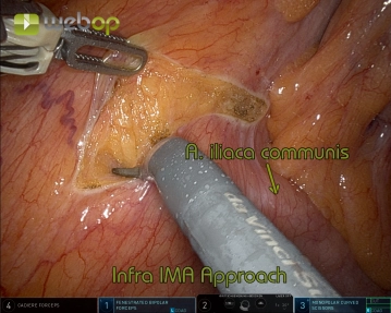 Absetzen der Gefäße 2