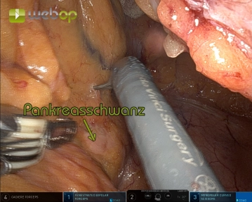 Mobilisation der linken Flexur von medial