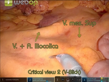 Präparation der ileokolischen Gefäße