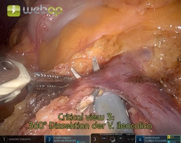 Durchtrennung der ileokolischen Gefäße 2