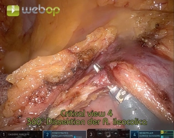 Durchtrennung der ileokolischen Gefäße 1