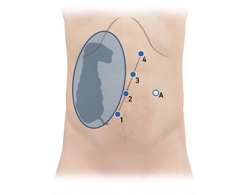 Trokarpositionierung und Docking 1