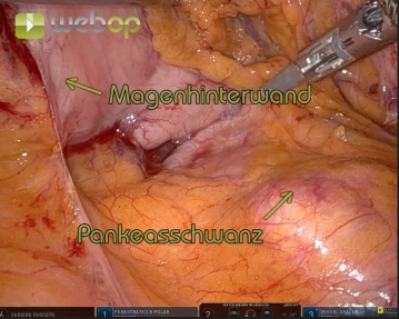 Eröffnung Bursa / Darstellung Pankreasoberrand