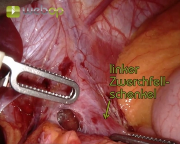 Präparation der Zwerchfellschenkel mit Eingang ins Mediastinum