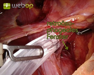 Anschlingen des distalen Ösophagus