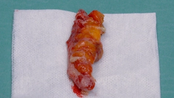 Extraktion des Bergebeutels