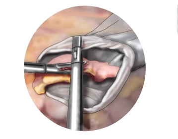Bergung der Appendix, Austupfen des Douglas