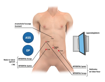 Anlage des Capnoperitoneums und Trokarpositionierung 