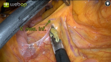  Präparation und Durchtrennung  der Vena mesenterica inferior 