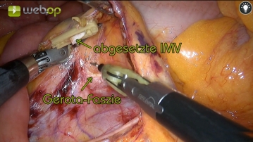 Mobilisation medial to lateral 