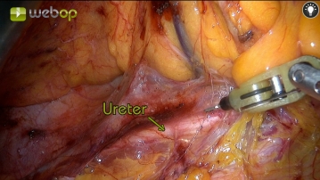 Mobilisation medial to lateral 