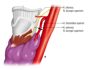 Präparation der oberen Polgefäße