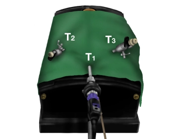 Trokarplatzierung
