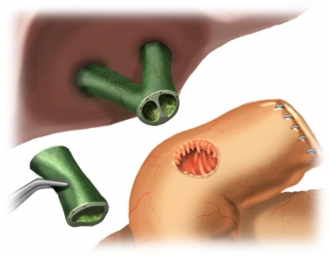 Präparation und Durchtrennung des Ductus hepatocholedochus