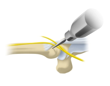 Eröffnen der Markhöhle
