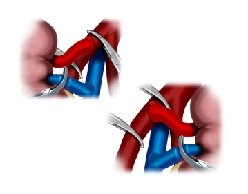 Anastomosendurchführung