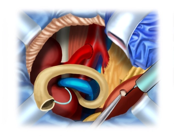Eröffnung der Harnblase