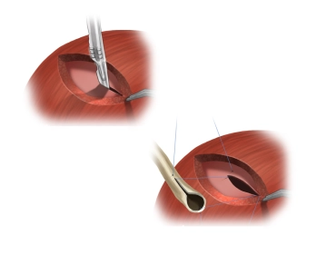 Ureterovesicale Anastomose