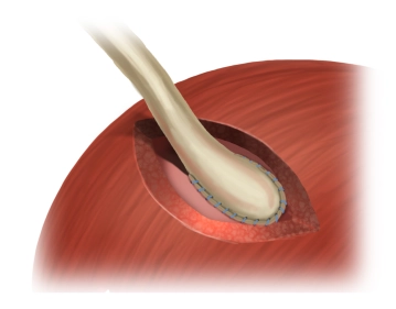 Dichteprüfung der Anastomose