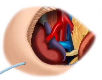 Drainage und Silikonkissen