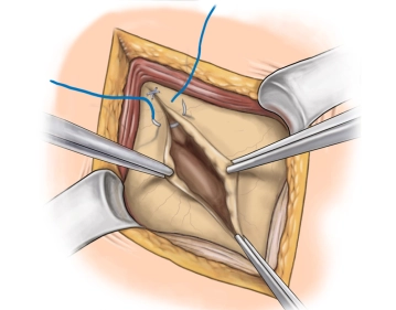 Bauchdeckenverschluss