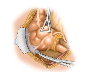 Mobilisierung Colon ascendens