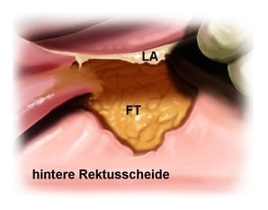 Präparation des Netzlagers