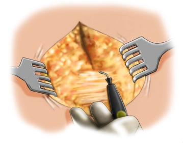 Freilegung des Fasziendefektes