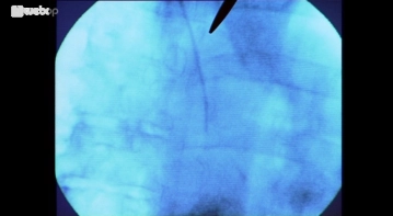 Einbringen des Portschlauchs