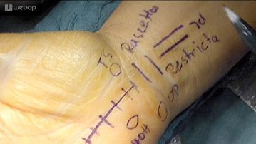 Planung/Hautinzision 2