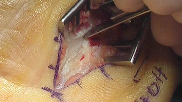 Durchtrennung Retinakulum flexorum 2