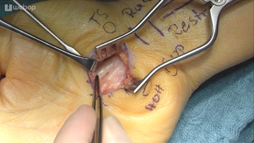 Darstellung und Inspektion Nervus medianus und Beugesehnen 2