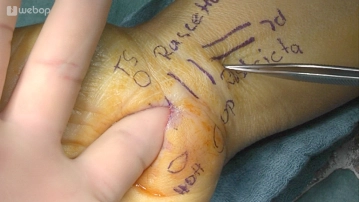 Digitaler Test Medianuskanal