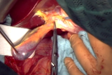 Cholezystektomie und Präparation des Lig. hepatoduodenale