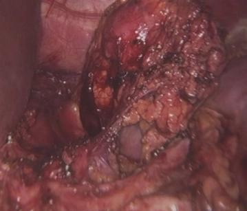 Exstirpation der Nebeniere in toto
