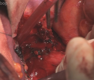 Eröffnung des Hiatus oesophageus mit Präparation des distalen Ösophagus