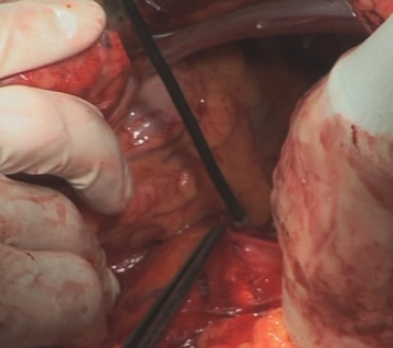 Duodenalmobilisation