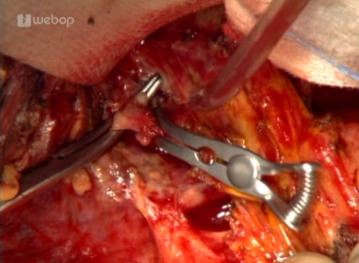 Präparation und Absetzen der Pfortader