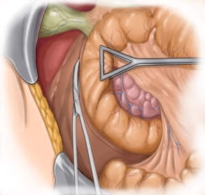 Inzision des paraduodenalen Peritoneums