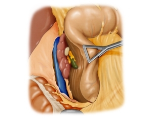 Mobilisation des Duodenums