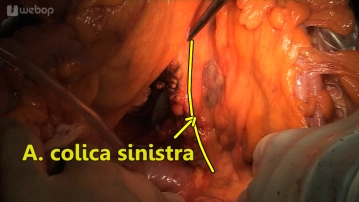 Absetzen der Arteria colica sinistra