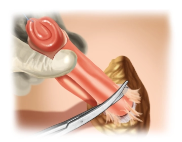 Mobilisierung und Präparation auf die Faszie