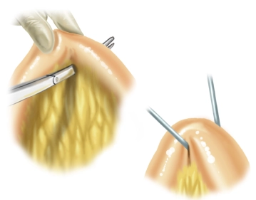 Anzügeln der Ileumschlinge